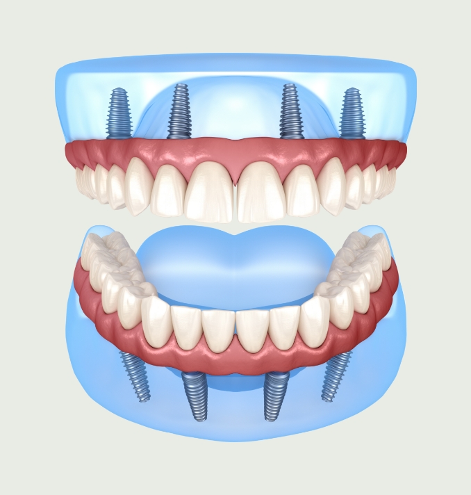 implant retained dentures