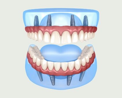 implant retained dentures